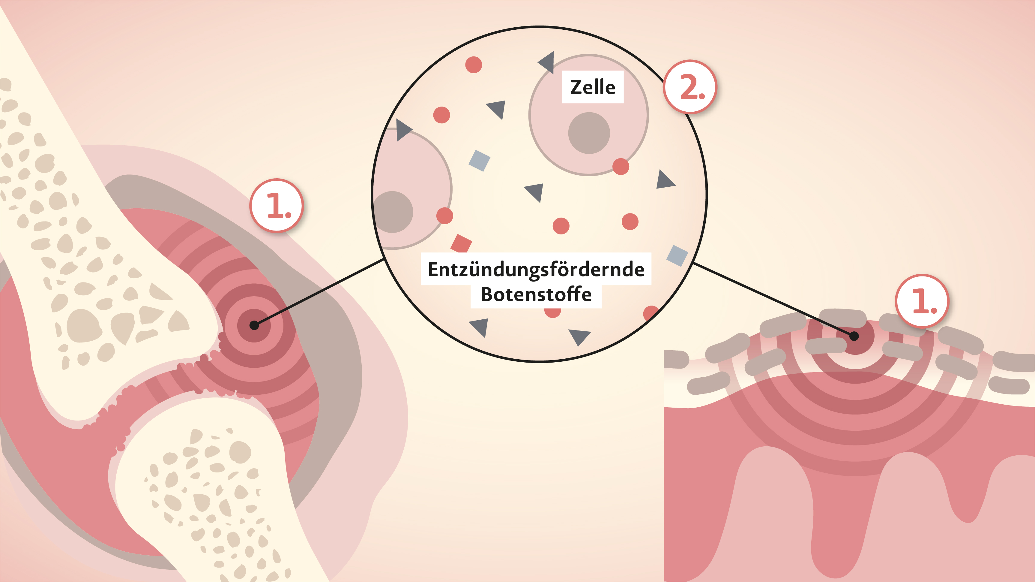 Rinvoq Wirkweise bei Psoriasis-Arthritis