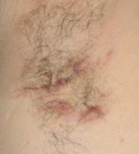 Acne inversa Erkrankung in der Achselhöhle.
