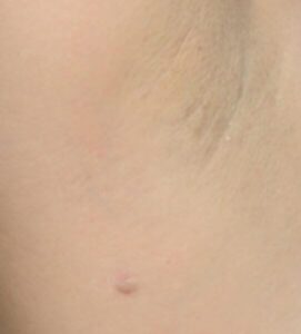 Acne inversa Erkrankung in der Achselhöhle.