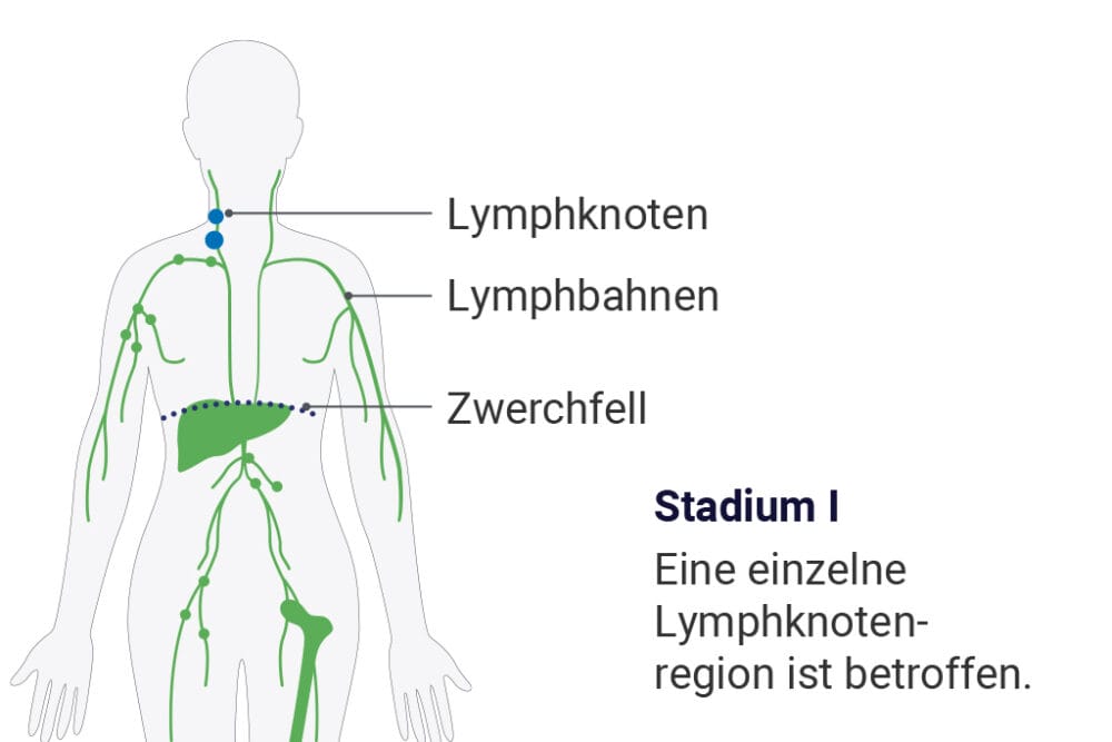 DLBCL diffuses großzelliges BZellLymphom