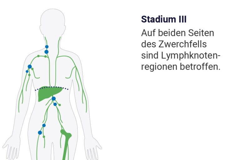 Diffus Großzelliges B Zell Lymphom www.abbvie-care.de