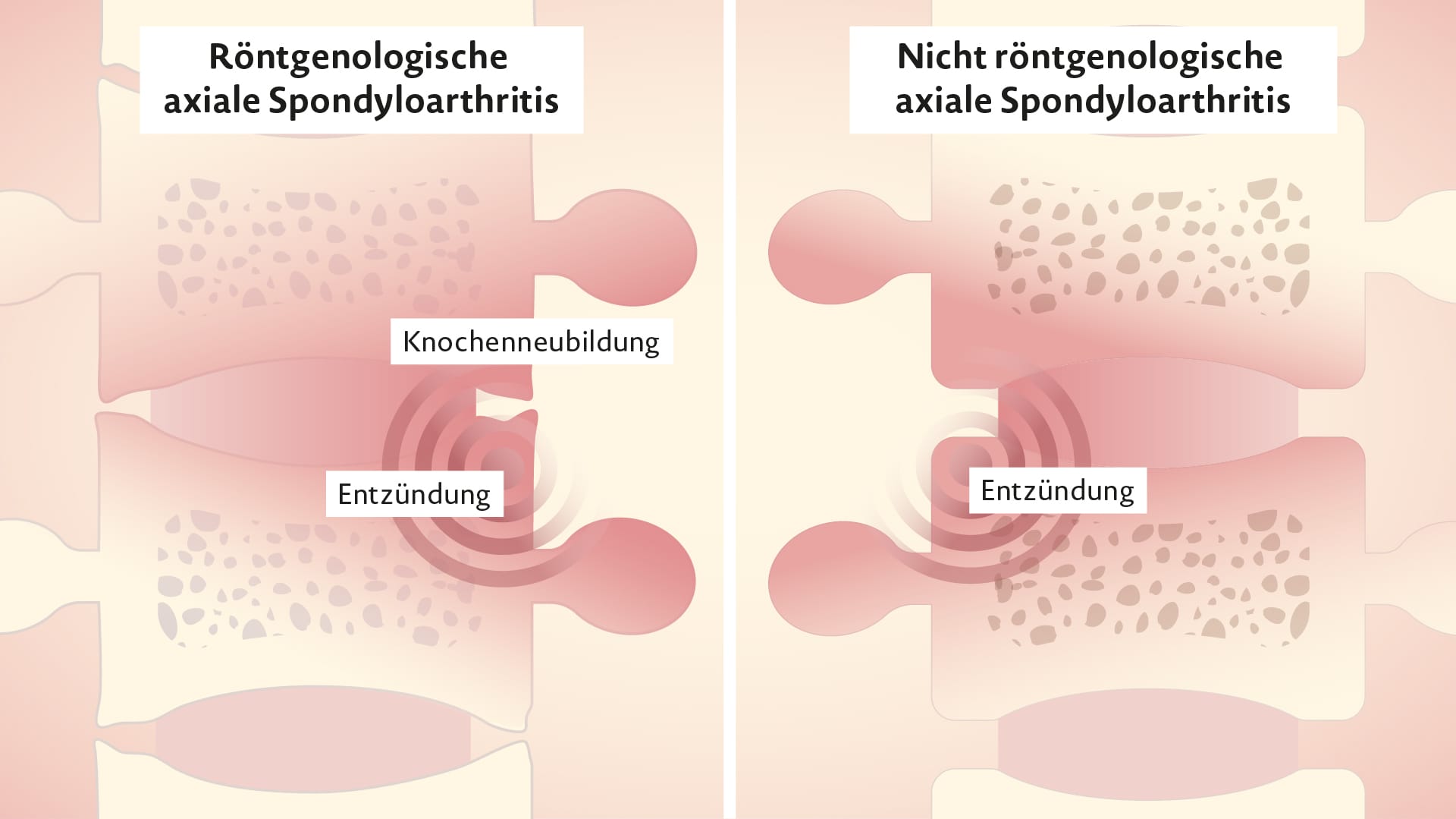 RINVOQ Wirkung bei AxSpa