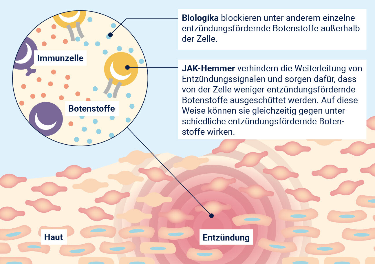 Der Entzündungsprozess bei Neurodermitis