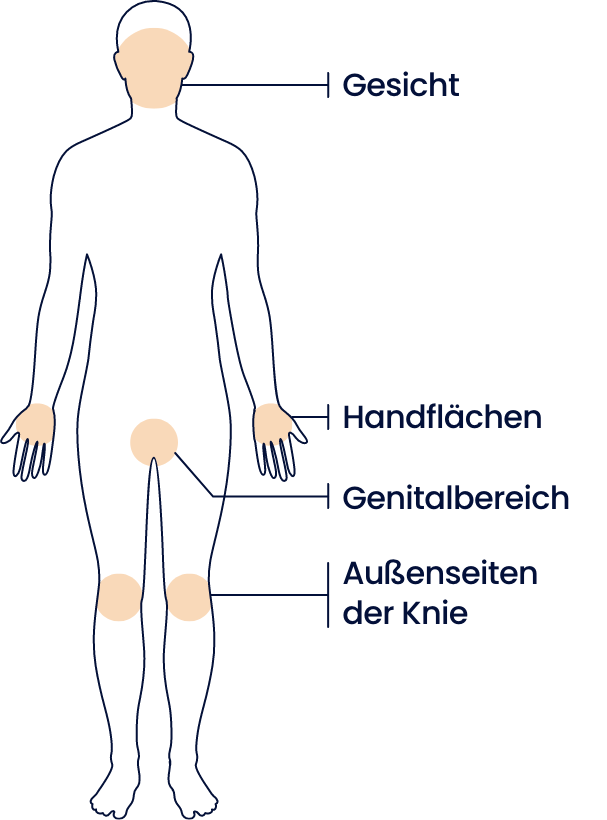 Mögliche betroffene Stellen einer Psoriasis gezeigt anhand einer Illustration des Oberkörpers von hinten