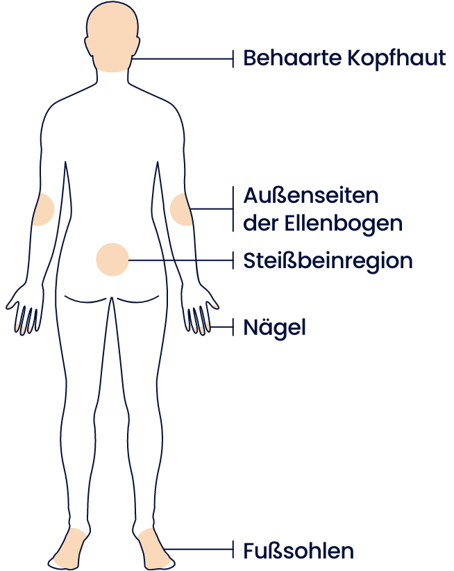 Mögliche betroffene Stellen einer Psoriasis gezeigt anhand einer Illustration des Oberkörpers von vorne